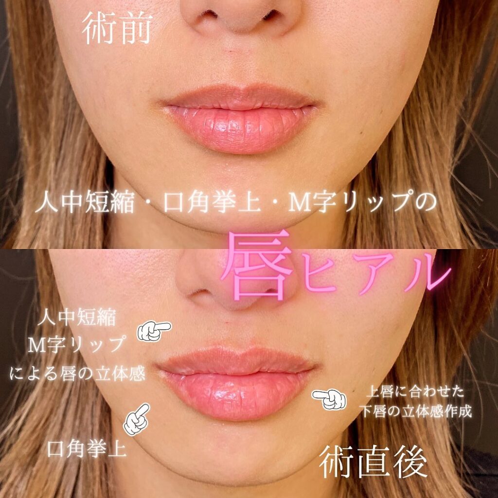 唇のヒアルロン酸の症例写真