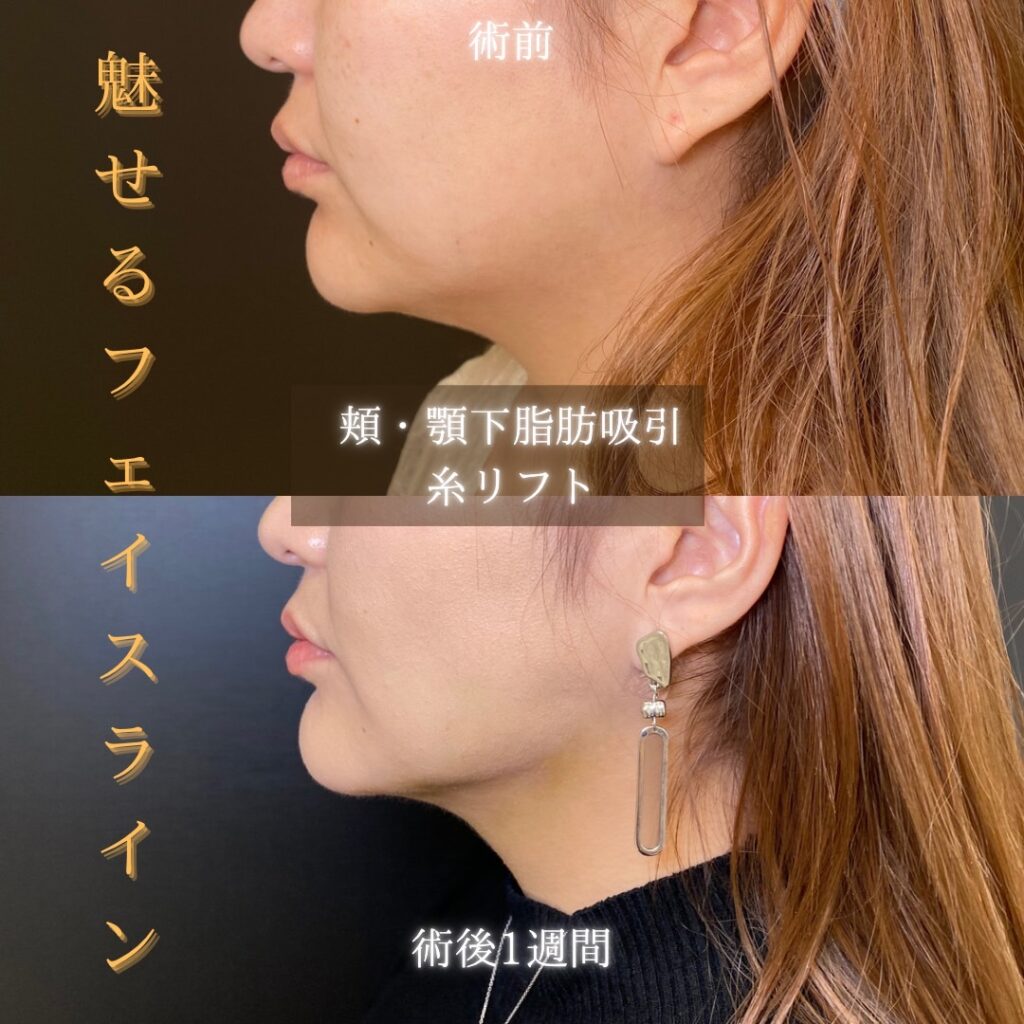 岡山院で行った頬と顎下脂肪吸引の症例写真