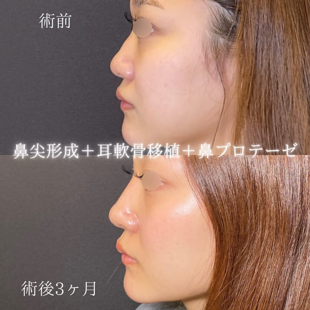 鼻尖形成と耳軟骨移植と鼻プロテーゼを岡山院で行った症例写真