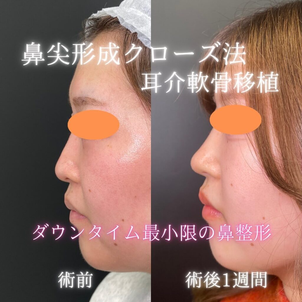 鼻尖形成と耳介軟骨移植の症例写真