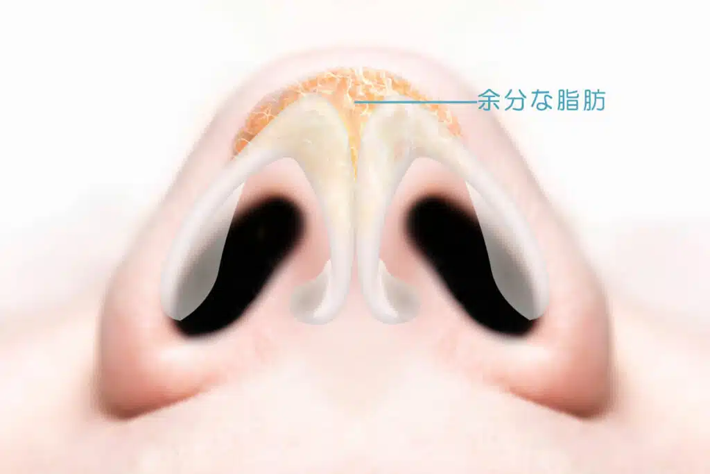 鼻尖形成