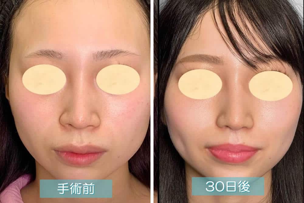 小鼻縮小手術の症例写真