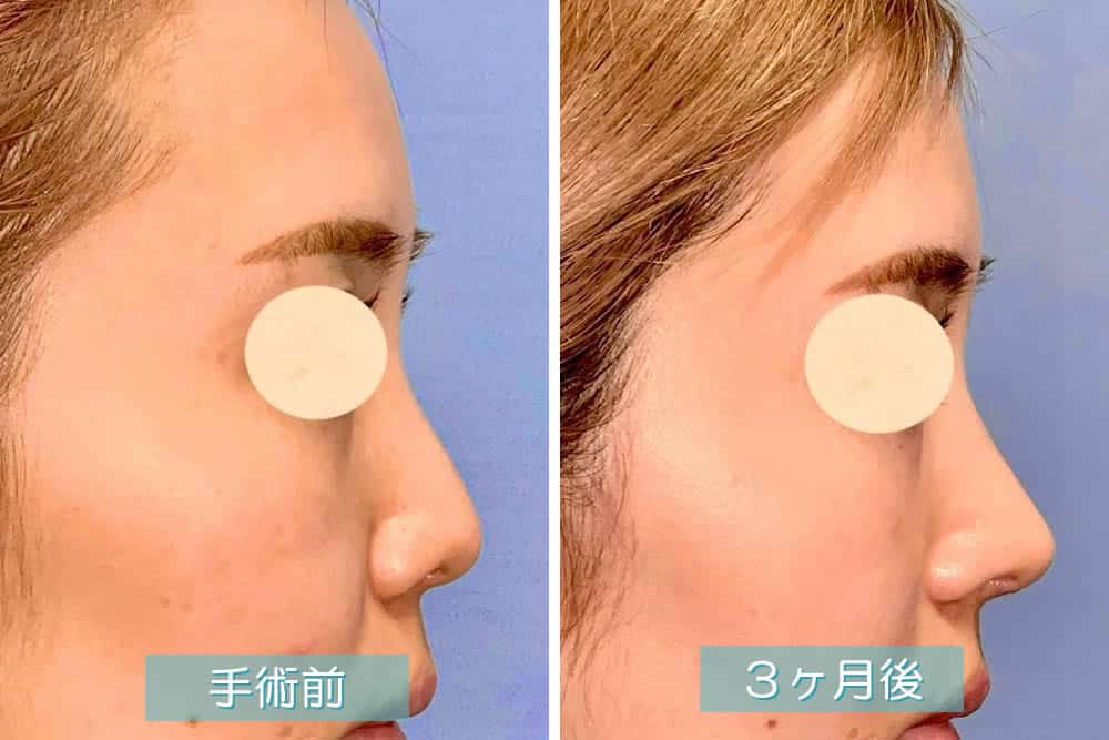 鼻尖部軟骨移植の3ヶ月後の症例写真