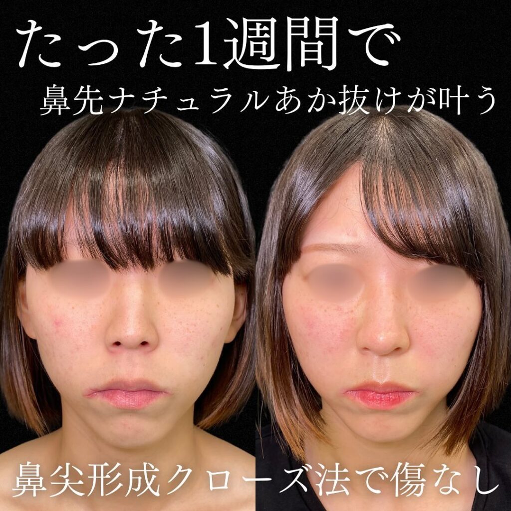 鼻尖形成クローズ法の症例写真