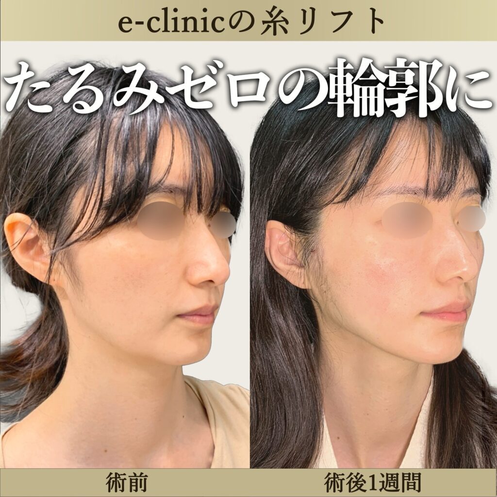 糸リフトの症例写真