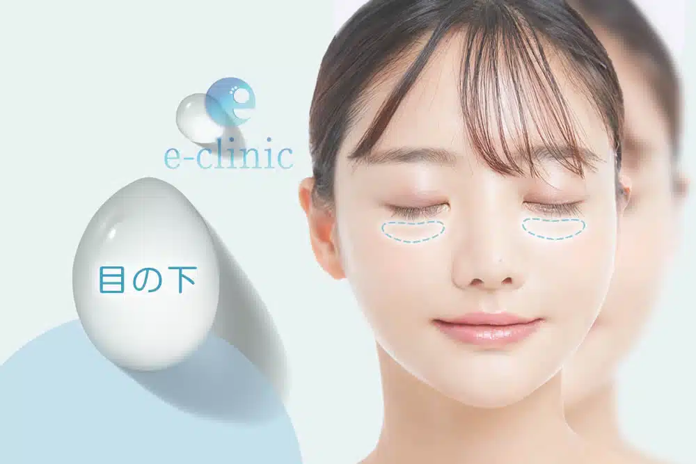 目の下 ほうれい線