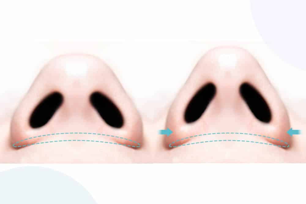 切らない小鼻縮小　岡山