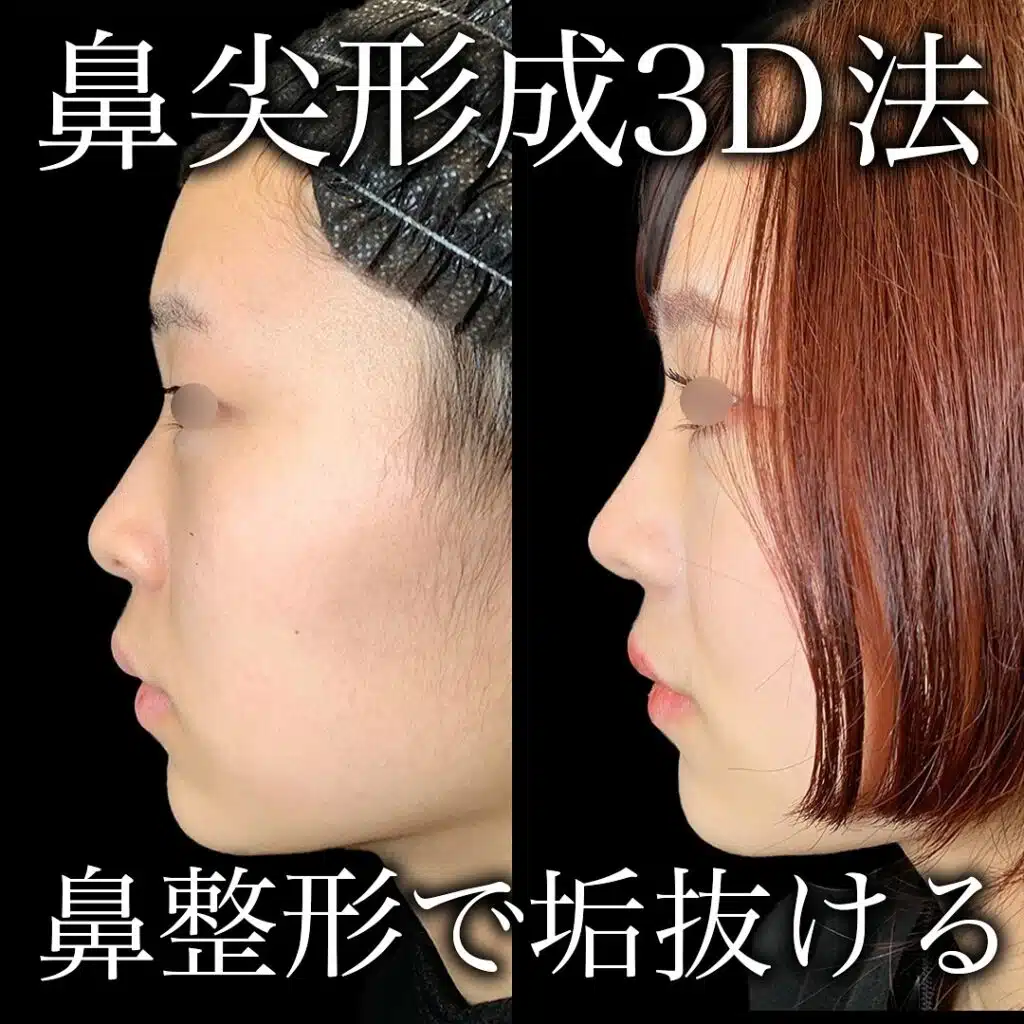 鼻尖形成
