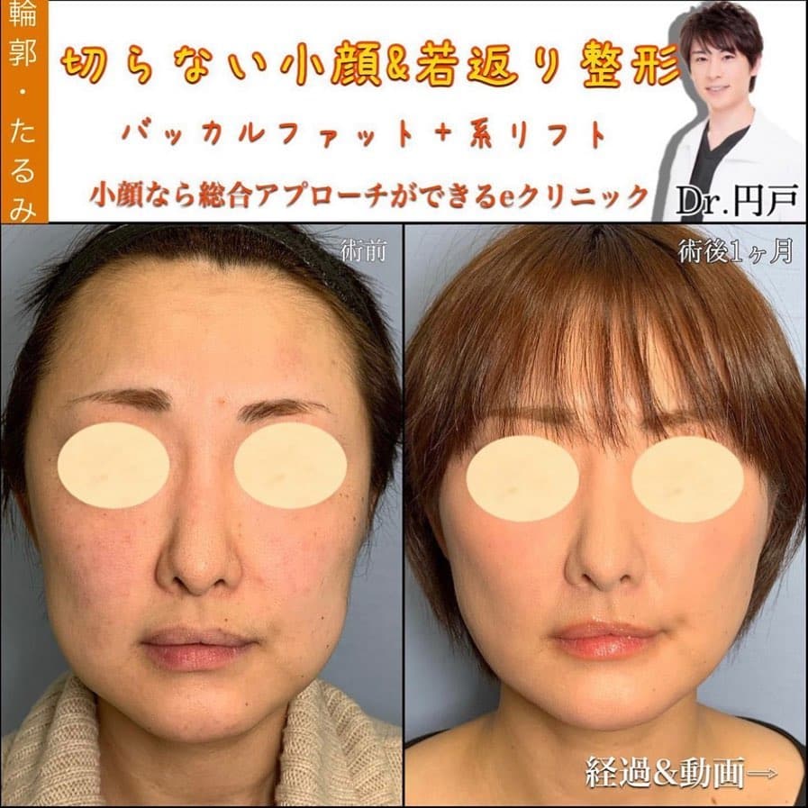 バッカルファット除去+糸リフトの症例写真