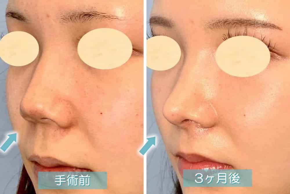 斜めから見た3ヶ月後の鼻唇角形成術・鼻柱下降術・猫手術の症例写真