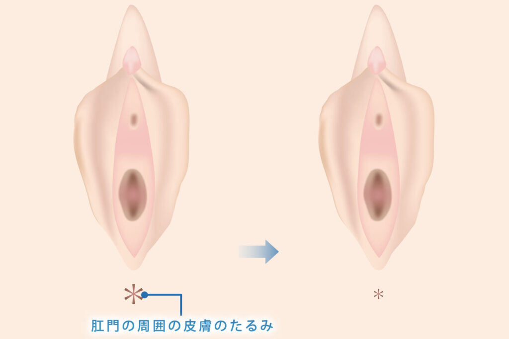 肛門の周囲のたるみ除去の図解