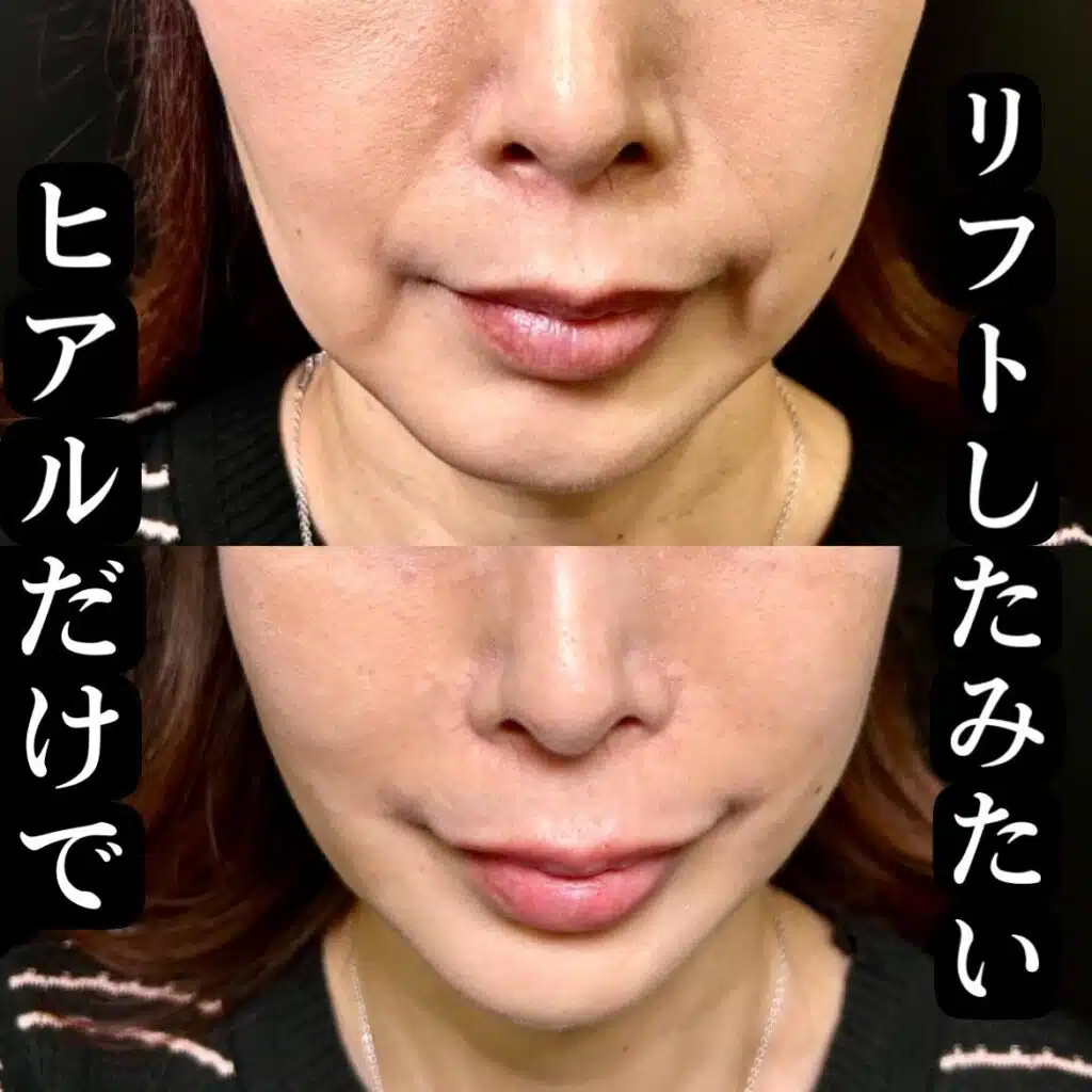 ヒアルロン酸
