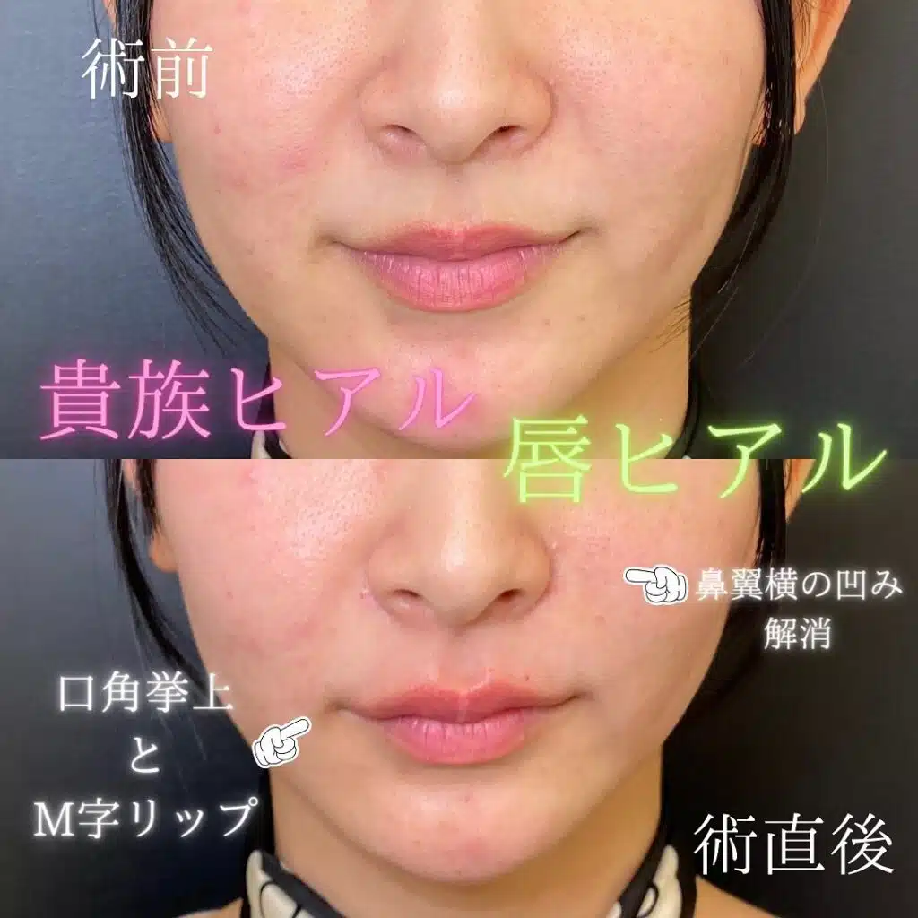 唇 ヒアルロン酸