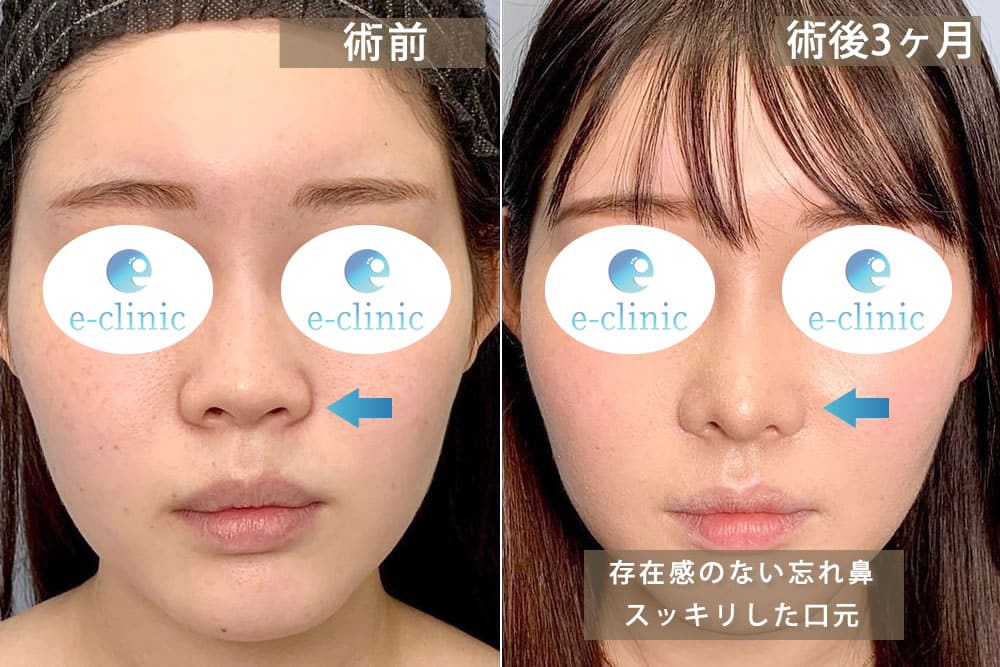 忘れ鼻の症例写真