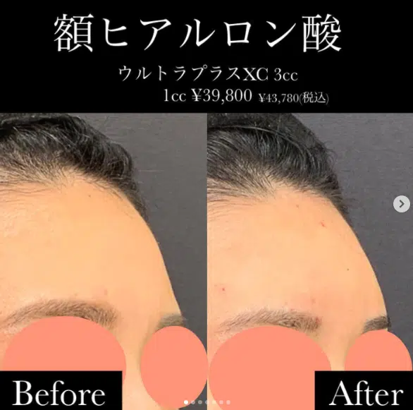 額 ヒアルロン酸
