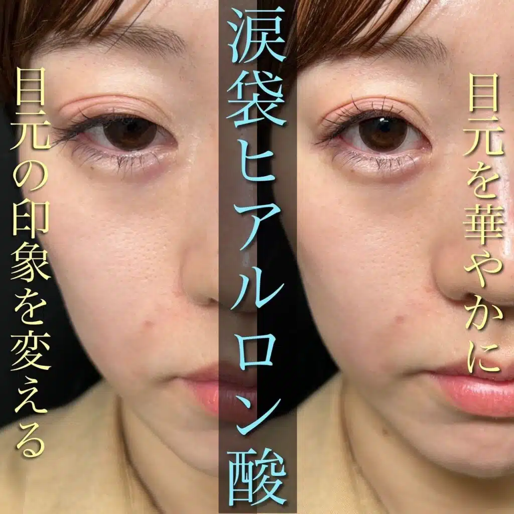 涙袋 ヒアルロン酸