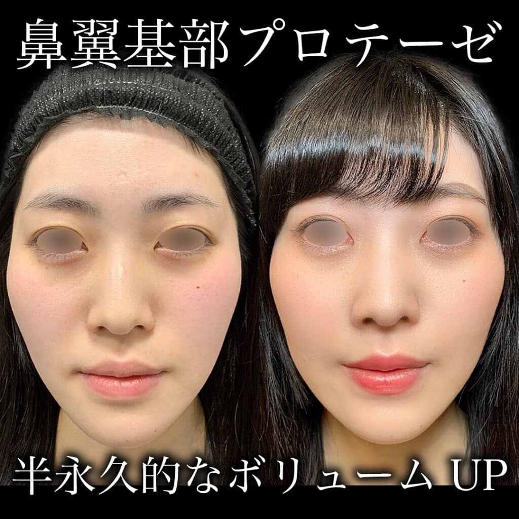 鼻翼基部プロテーゼの症例写真