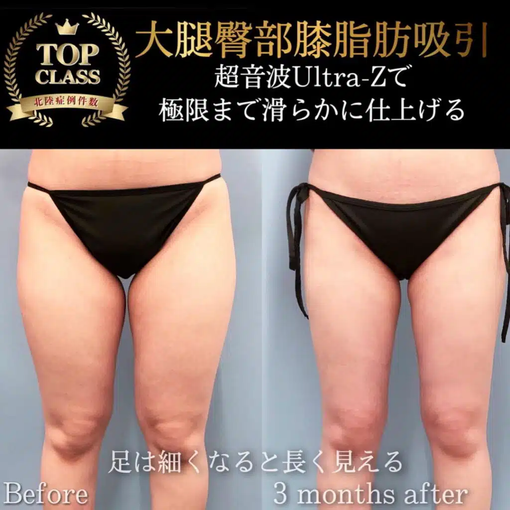 太ももの脂肪吸引