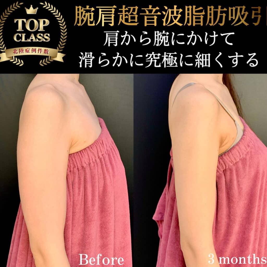 脂肪吸引の症例写真
