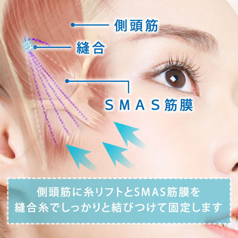 ハイブリッドリフトフェイスリフトの図解 (1)