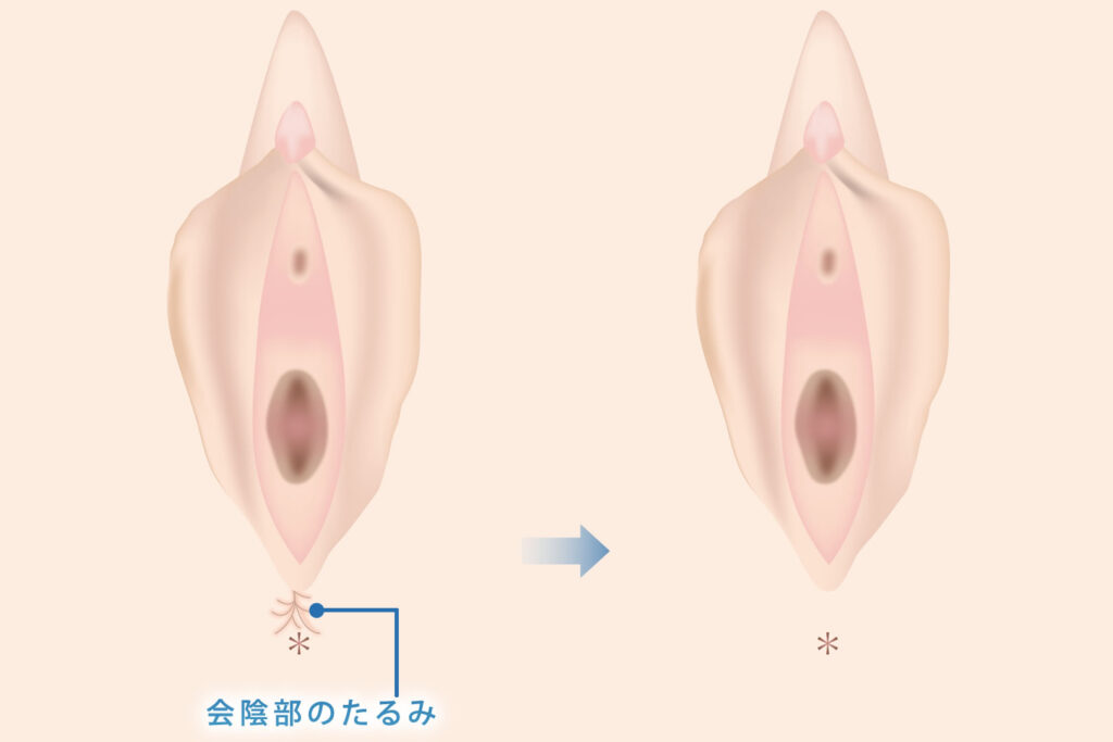 会陰部贅皮切除術の症例イメージ