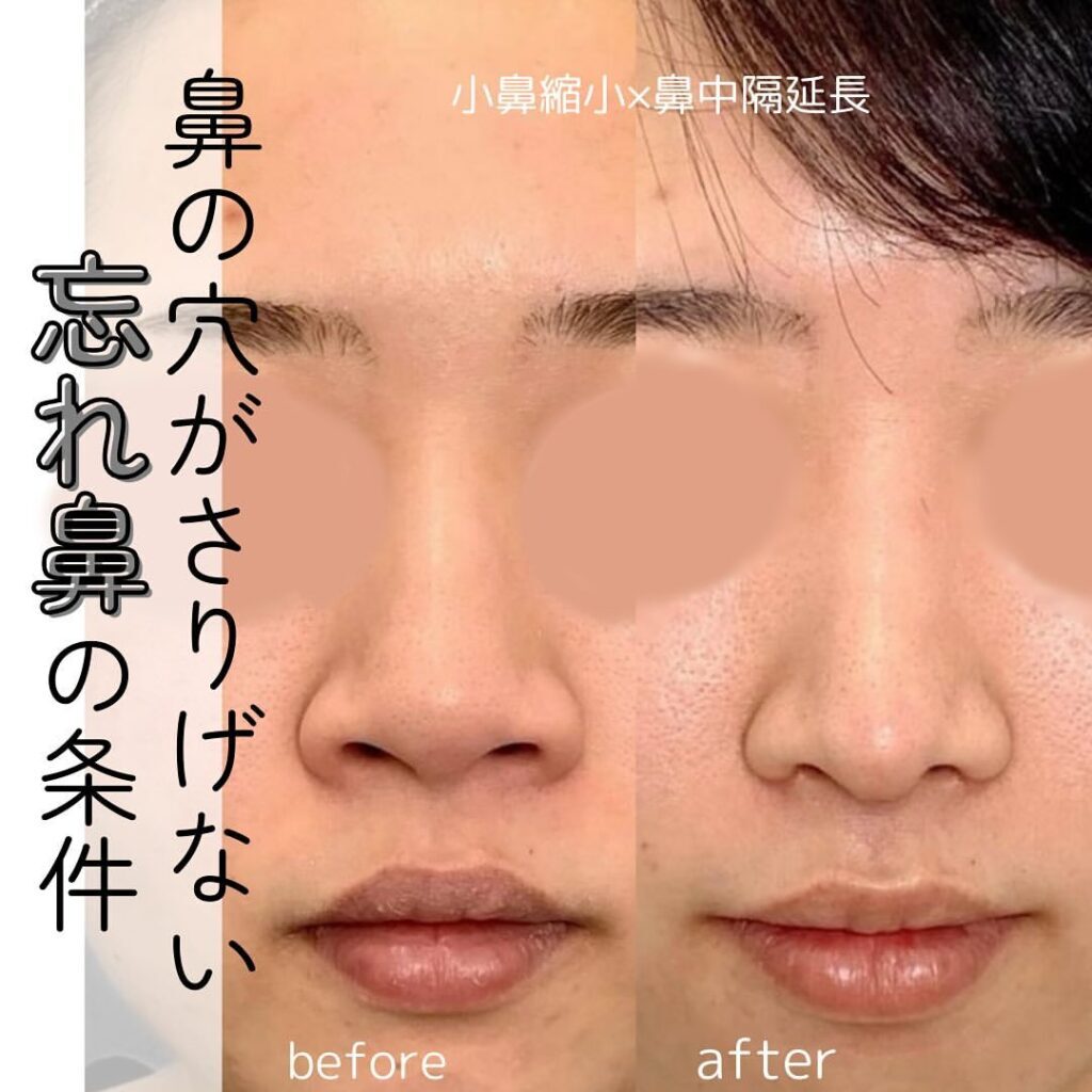 小鼻縮小+鼻中隔延長の症例写真