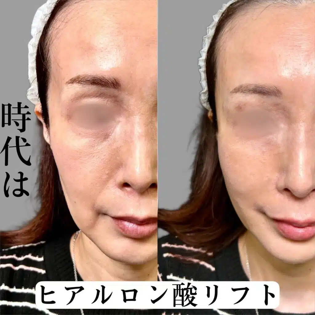 ヒアルロン酸 リフト