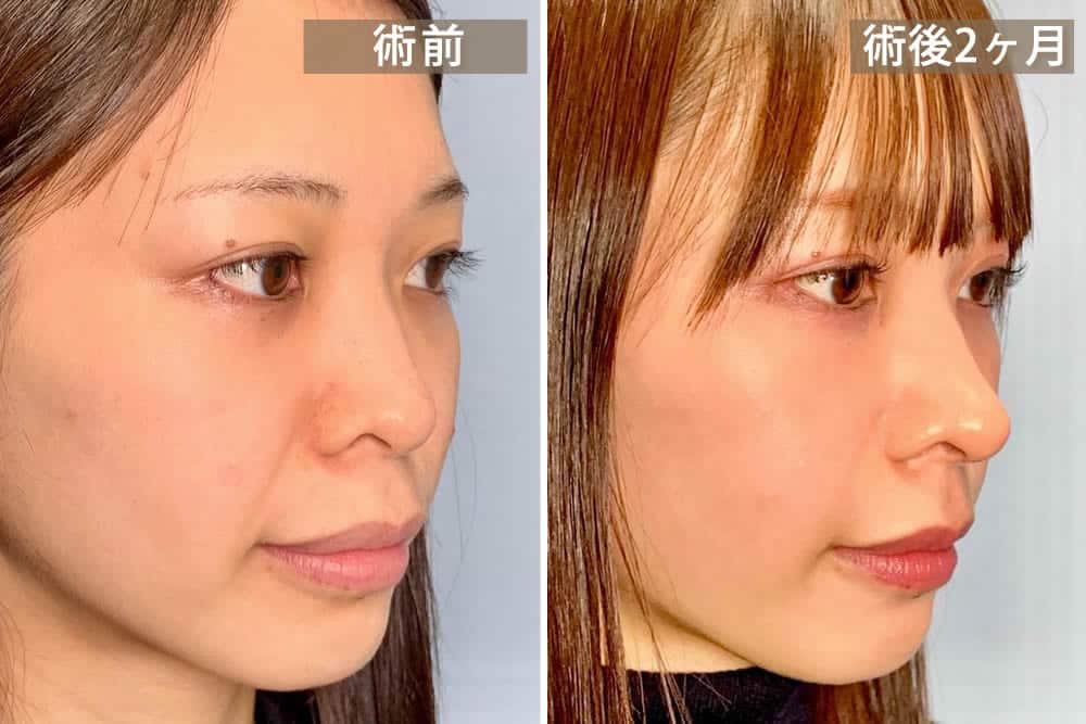 軟骨移植と鼻中隔延長手術を併用した症例写真