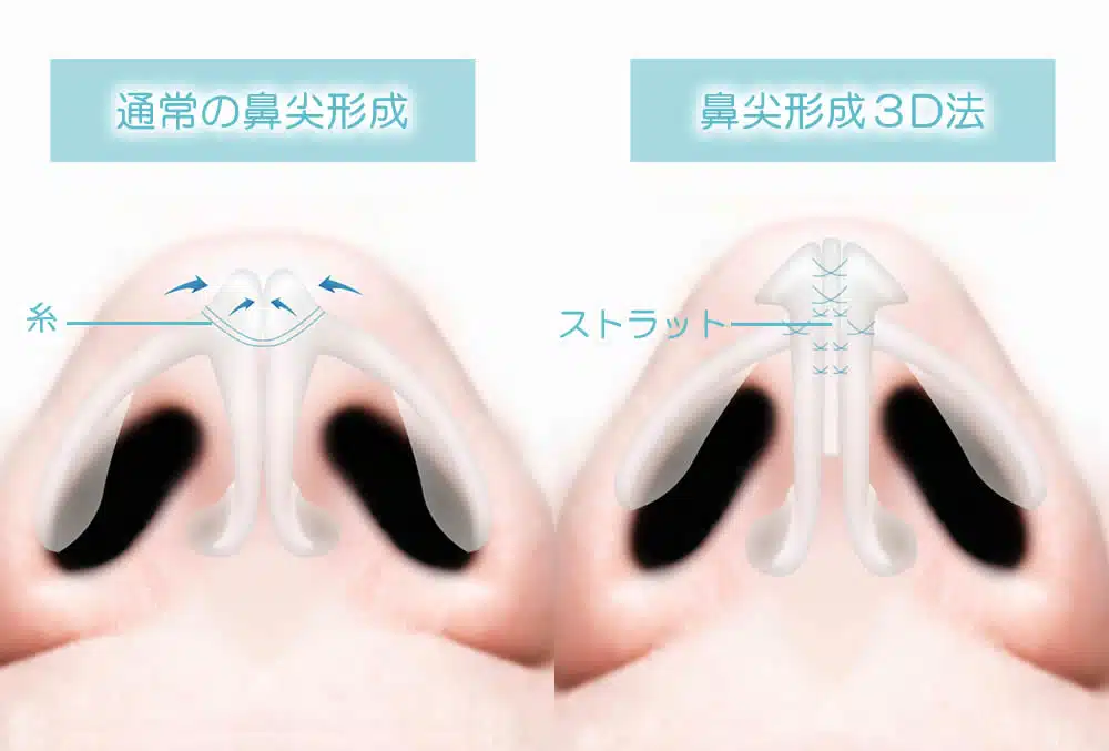 鼻尖形成