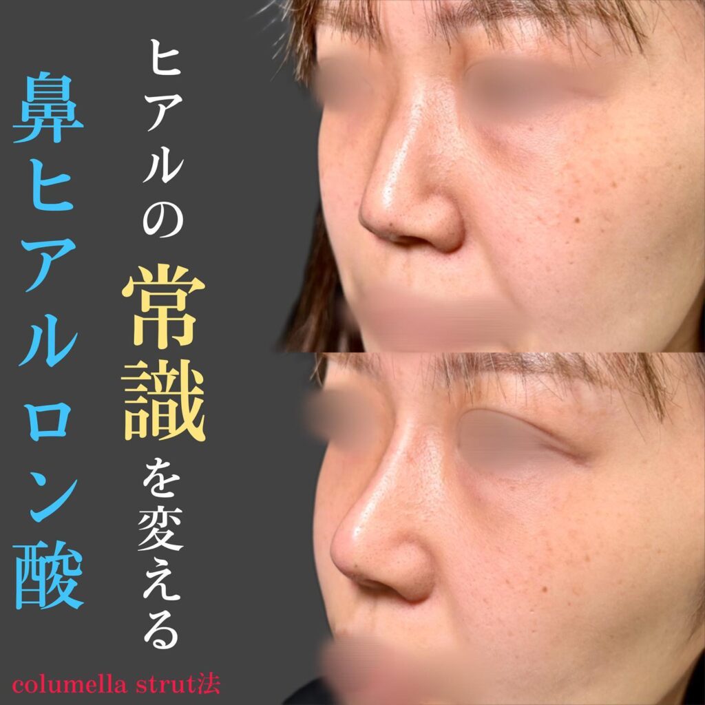 鼻整形のヒアルロン酸の症例写真