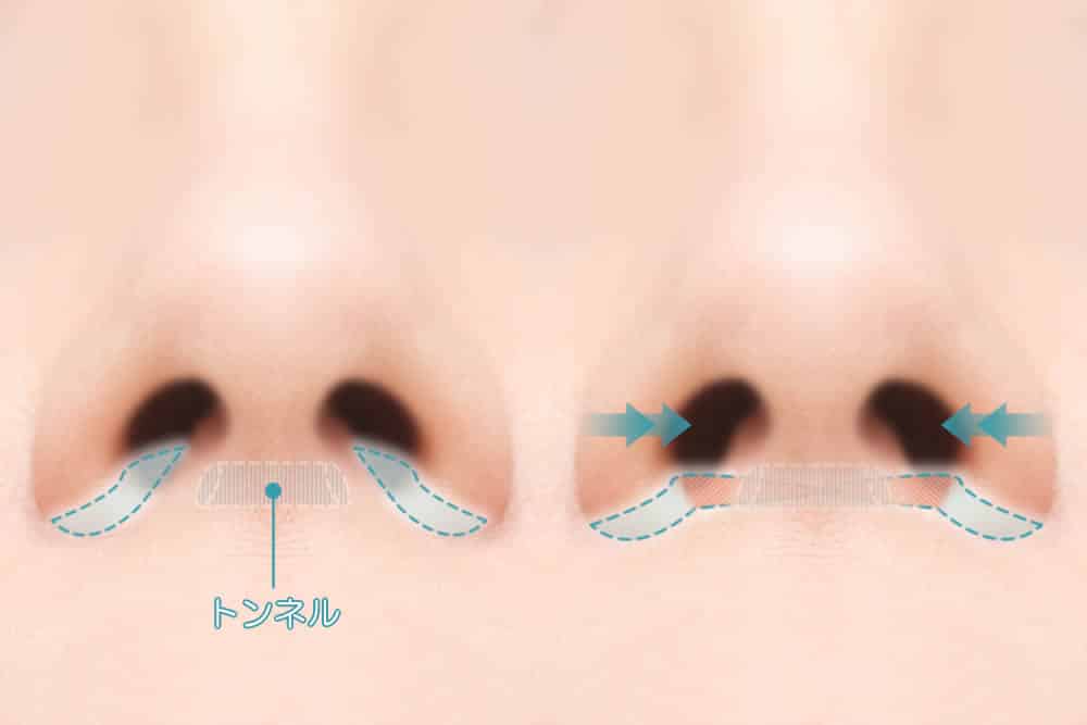 小鼻縮小　フラップ法　岡山