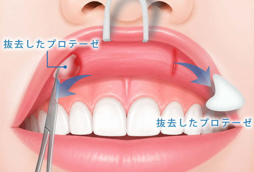貴族手術のプロテーゼを抜去している図解