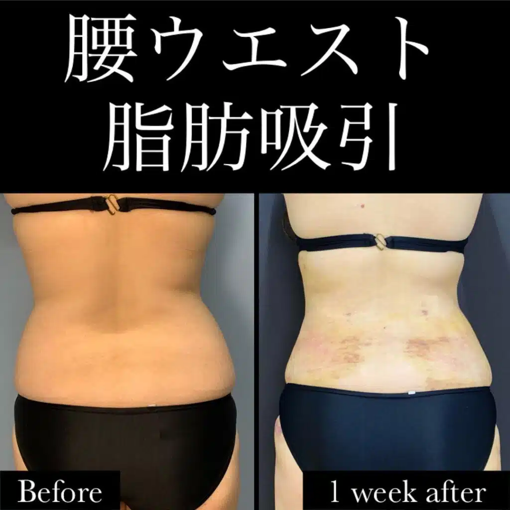 腰の脂肪吸引