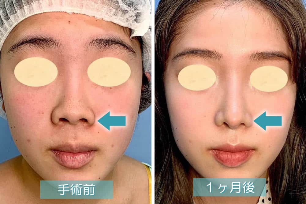 鼻尖形成で鼻が小さくなった症例写真