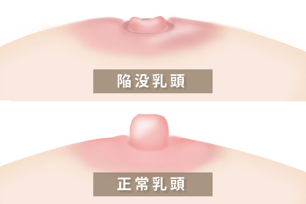 陥没乳頭と正常乳頭の違い