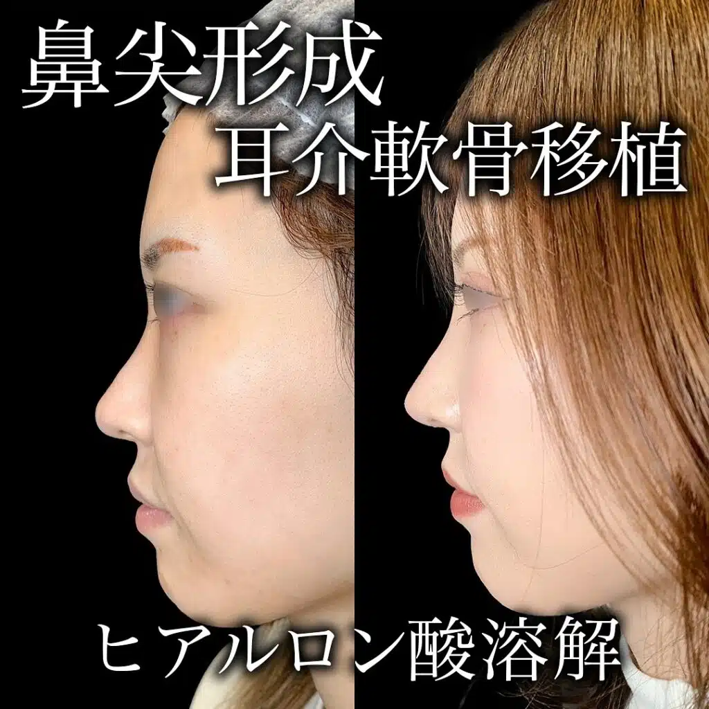 鼻尖形成