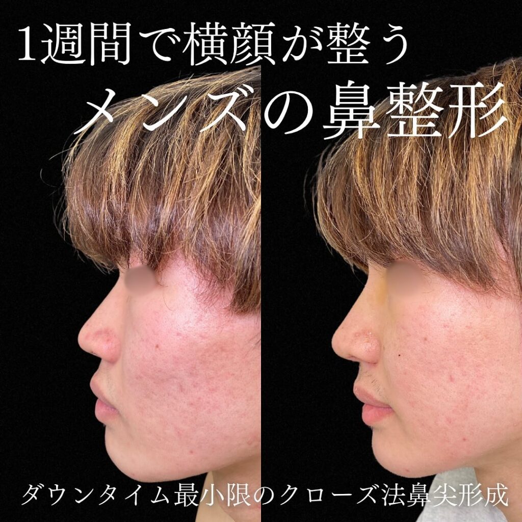 鼻尖形成クローズ法の症例写真