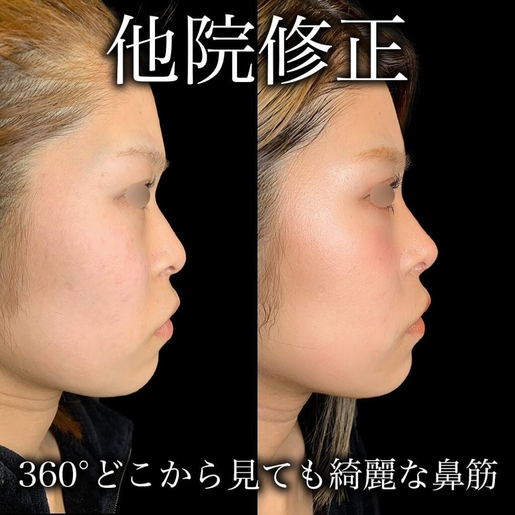 鼻の他院修正で鼻尖形成とプロテーゼを行った症例写真
