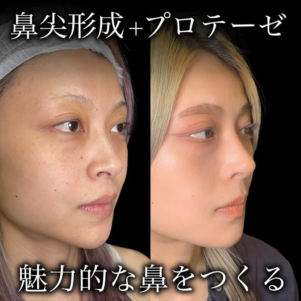 鼻尖形成+プロテーゼの症例写真