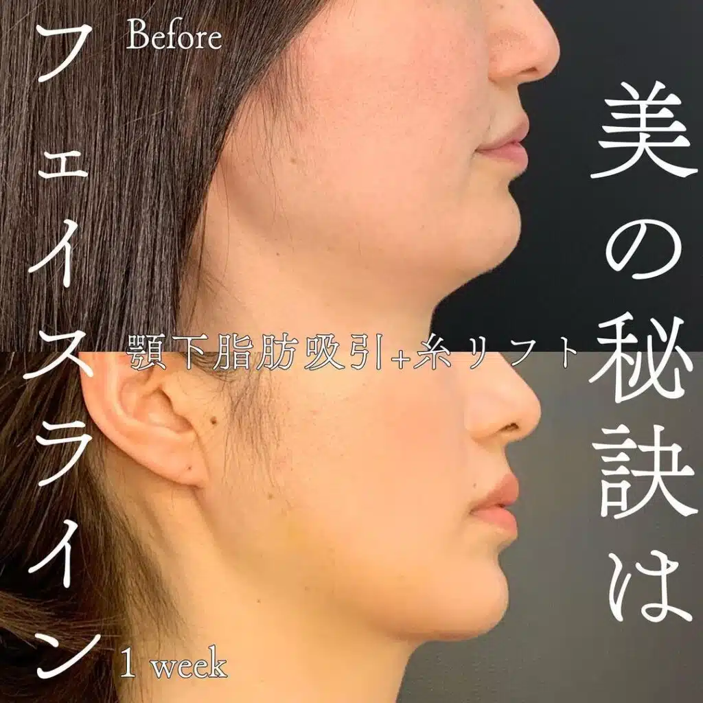顎下の脂肪吸引