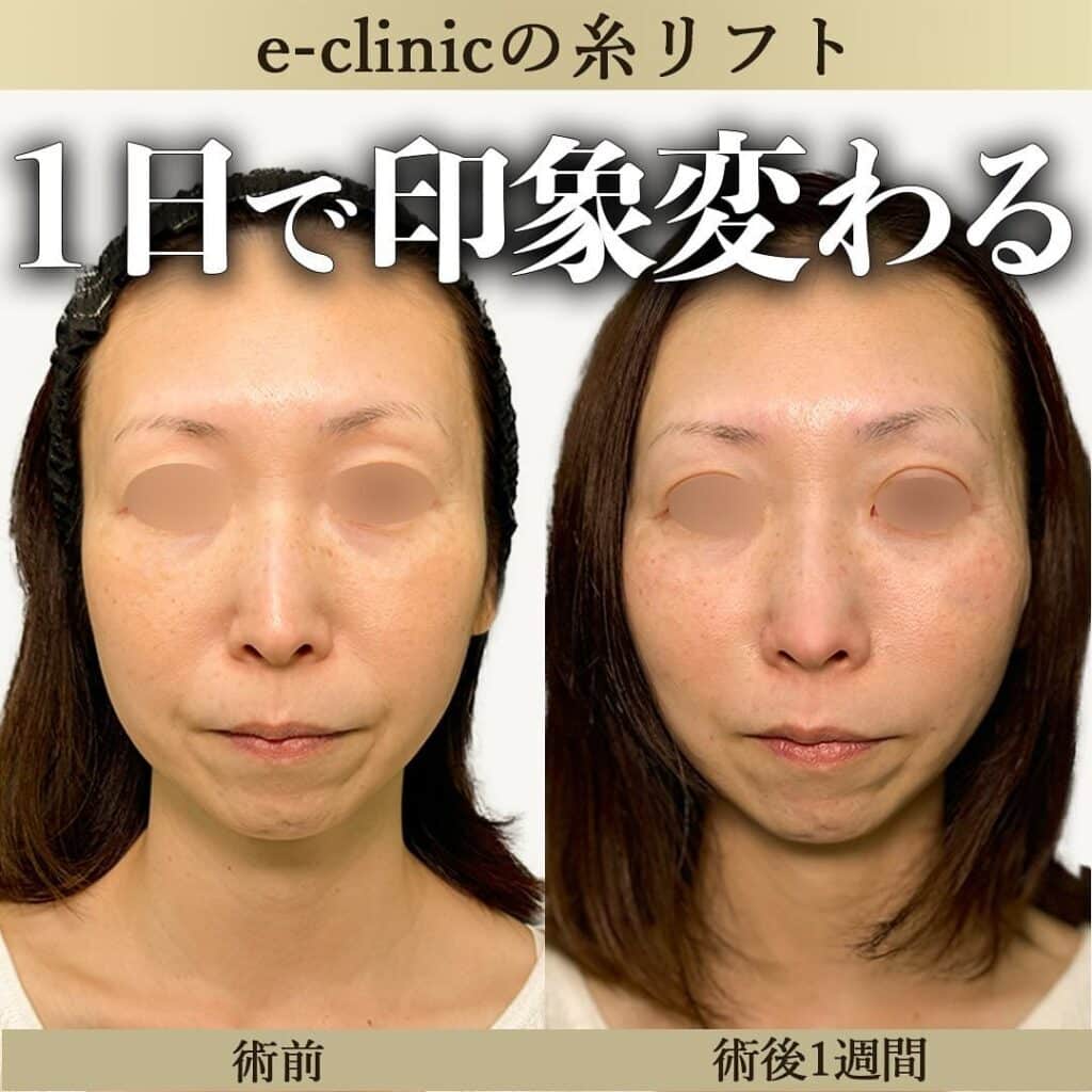 糸リフトの症例写真