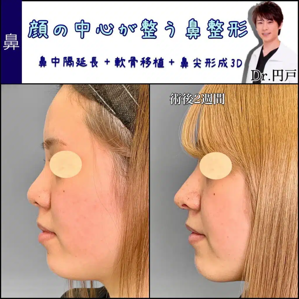 鼻尖形成