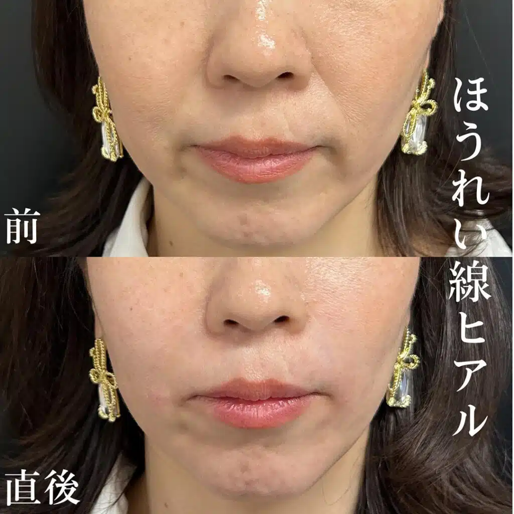 ほうれい線 ヒアルロン酸