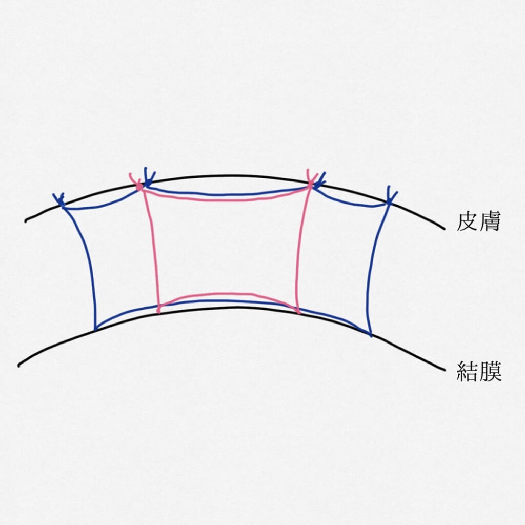 multiple knot法の図 (1)