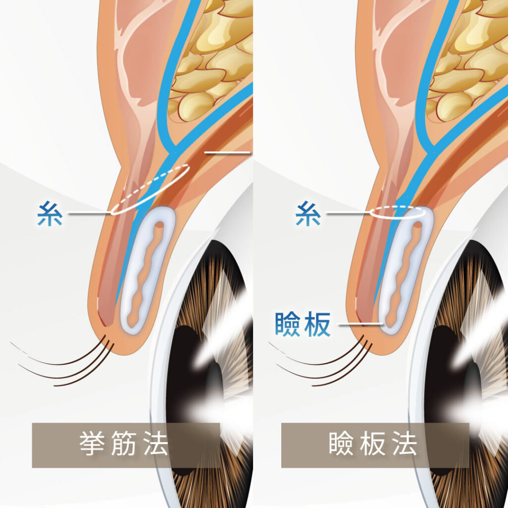 瞼板法と挙筋法を比較した図