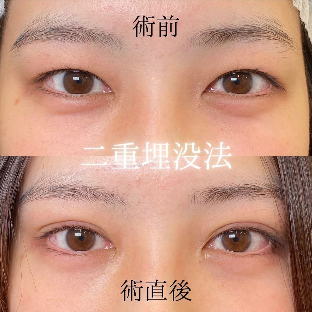 埋没法の術前と直後の症例