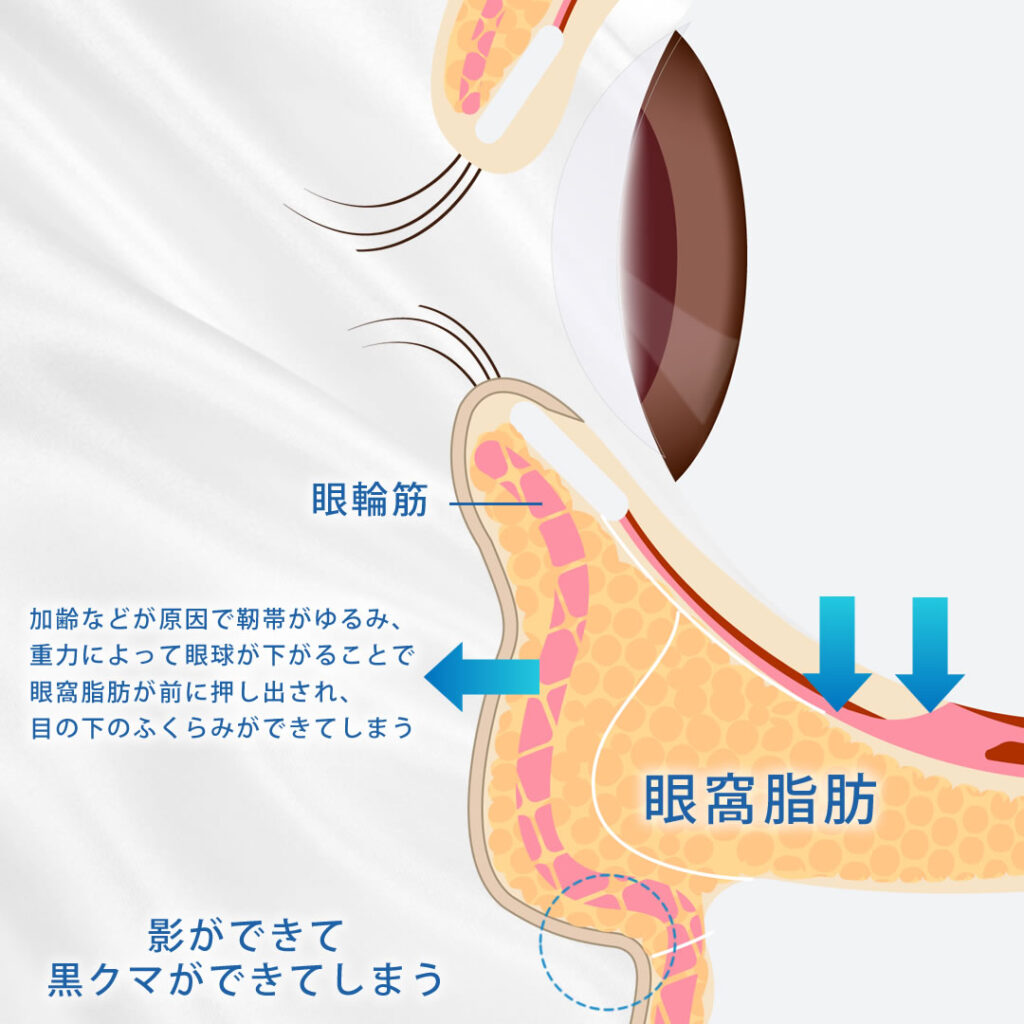 眼窩脂肪の図解