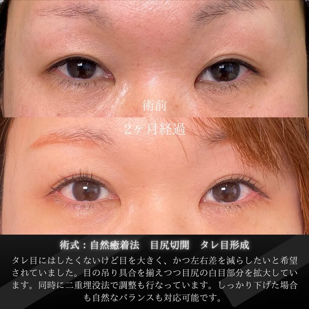 岡山院の自然癒着法と目尻切開とタレ目形成の２ヶ月後の症例写真