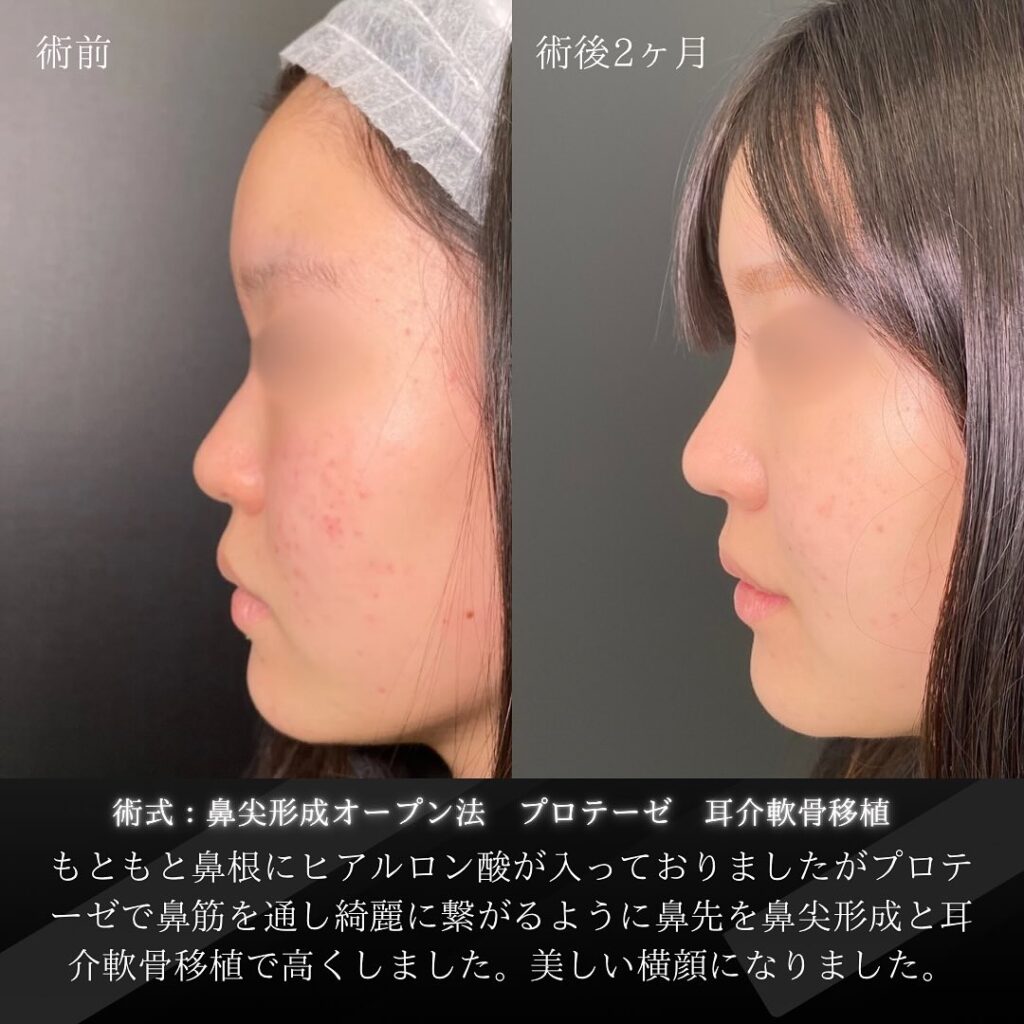 岡山院の鼻尖形成とプロテーゼと耳介軟骨移植の２ヶ月後の症例写真