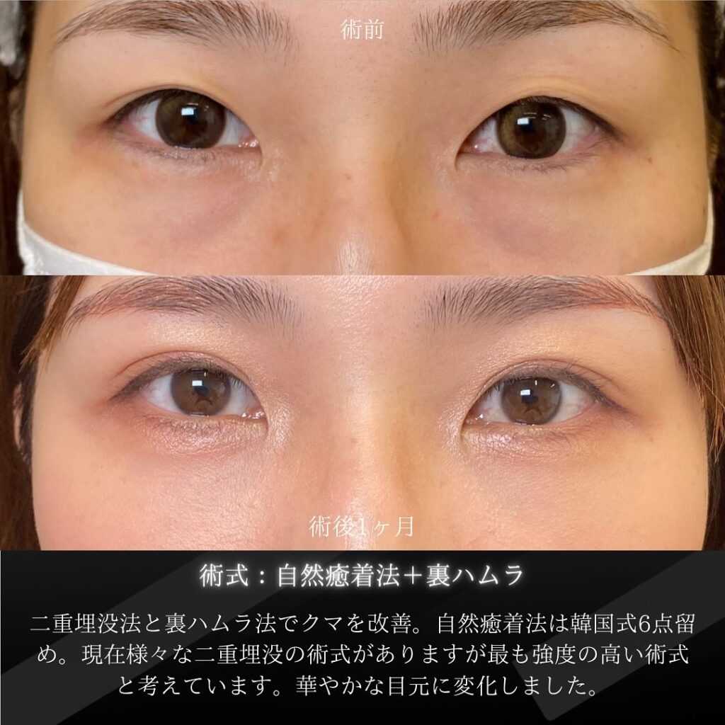岡山院の自然癒着法と裏ハムラの３ヶ月後の症例写真